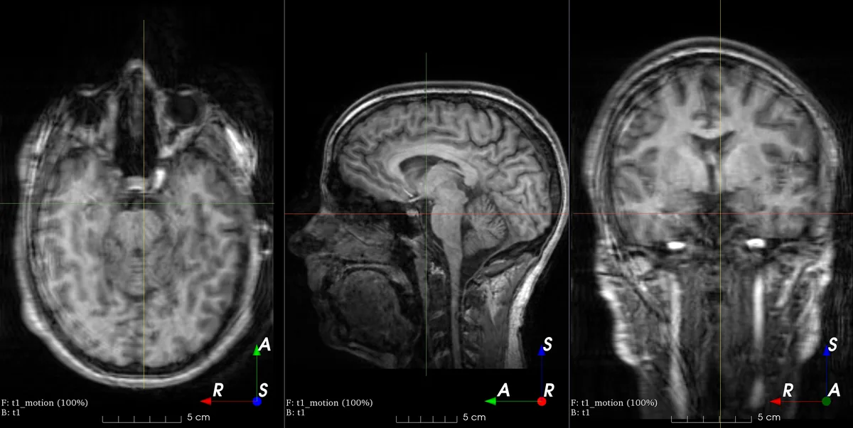 Brain scan with the augmentation applied
